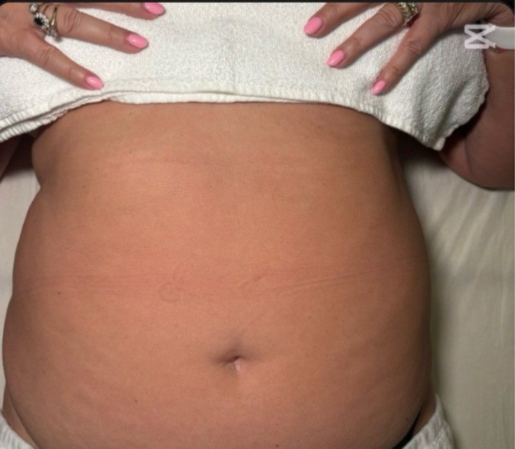 Before — Body contour