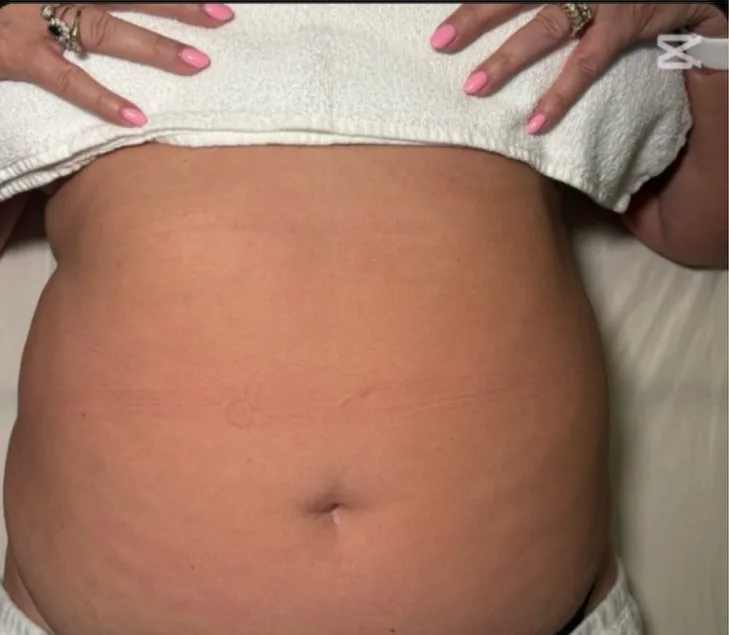 Before — Body contour